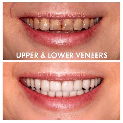 How Long Do Veneers Last .